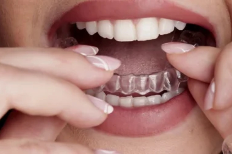 Invisalign