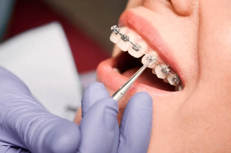 Aligners